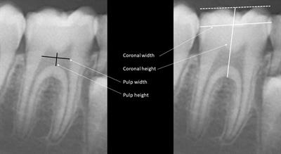 Dental health of pediatric patients with X-linked hypophosphatemia (XLH) after three years of burosumab therapy